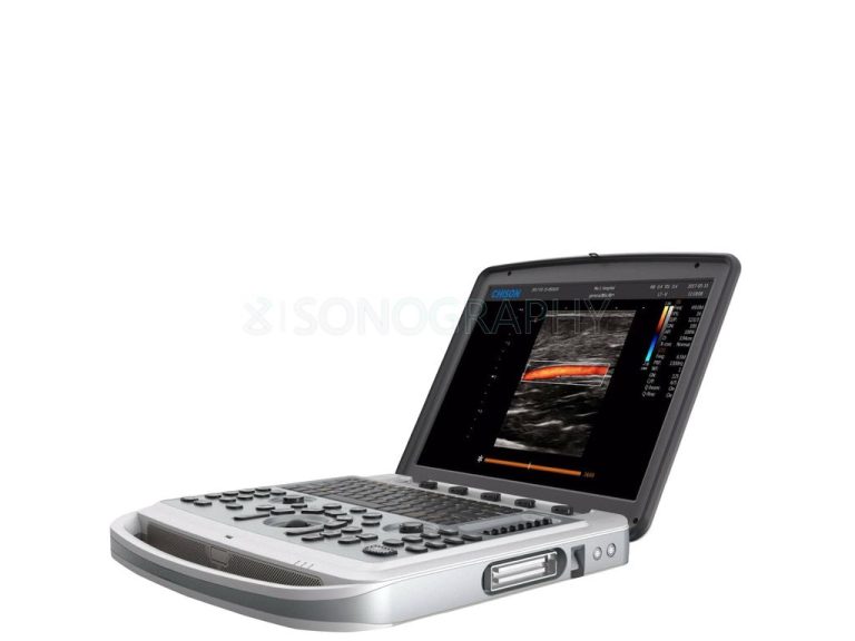 Изображение УЗИ аппарат Chison SonoTouch 80, (ST 80), (SonoBook 6)